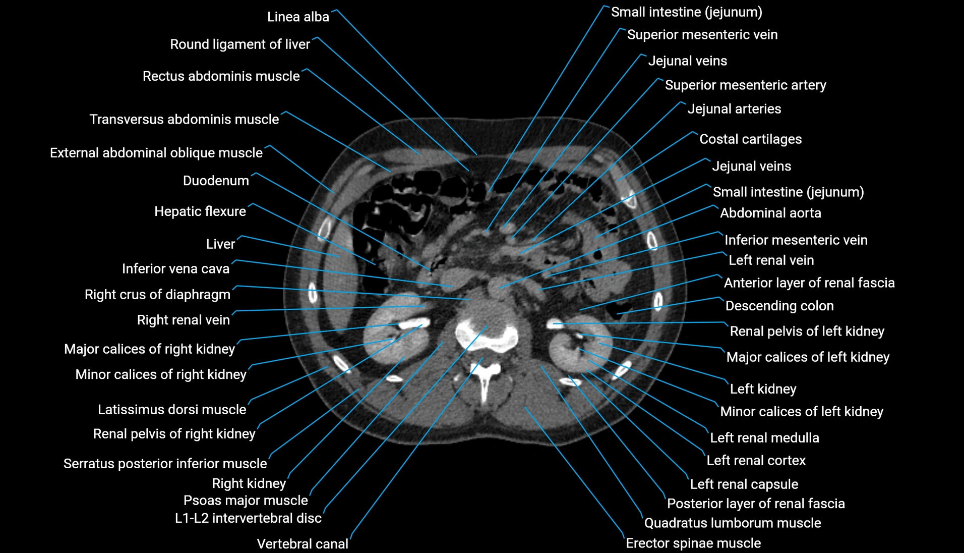 CT urogram axial cross sectional anatomy  labelled radiology image-00103.webp